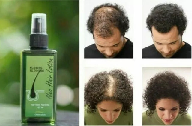 Neo Hair Lotion 120ml – Natural Herbal Hair Regrowth Treatment for Thinning Hair & Hair Loss, 100% Authentic with QR Code – Made in Thailand