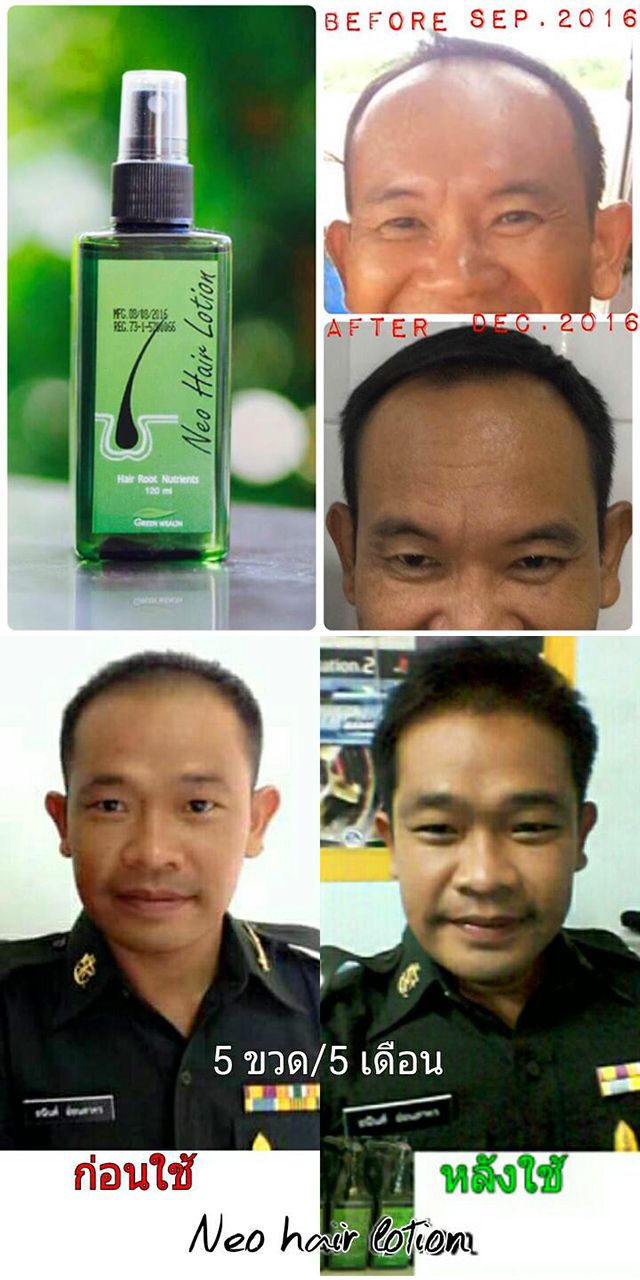 Neo Hair Lotion 120ml – Natural Herbal Hair Regrowth Treatment for Thinning Hair & Hair Loss, 100% Authentic with QR Code – Made in Thailand
