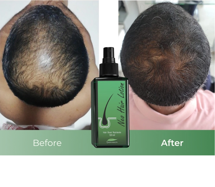 Neo Hair Lotion 120ml – Natural Herbal Hair Regrowth Treatment for Thinning Hair & Hair Loss, 100% Authentic with QR Code – Made in Thailand
